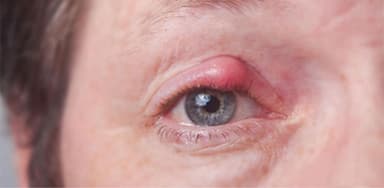 Chắp mắt trẻ em và những điều cần biết