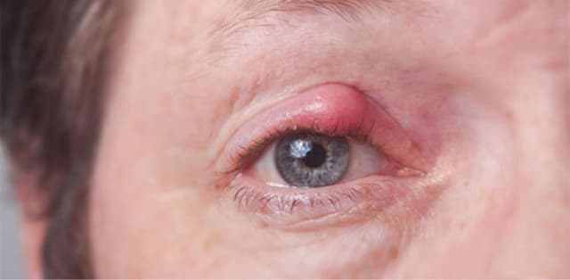 Chắp mắt trẻ em và những điều cần biết