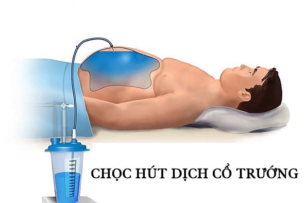 chọc dịch cổ trướng