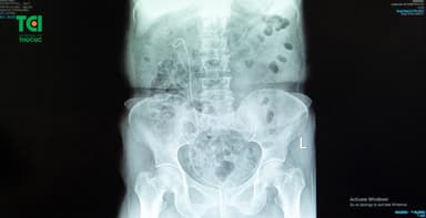 Đặt ống sonde jj niệu quản trong điều trị sỏi tiết niệu