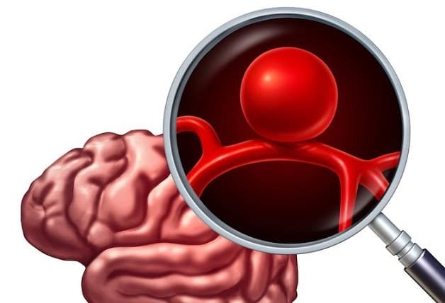 Đau đầu khó ngủ do phình mạch não 