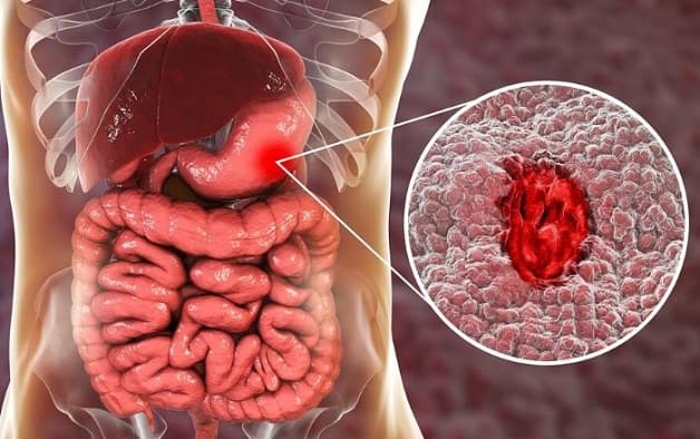 Viêm loét dạ dày là bệnh thường gặp ở hệ tiêu hóa 