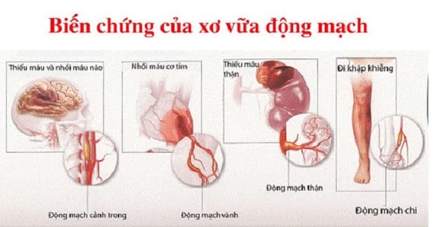 Người bị cao huyết áp, xơ vữa động mạch, bệnh tiểu đường cần lưu ý dấu hiệu của tai biến mạch máu.