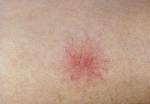 mao mạch hình sao là dấu hiệu xơ gan