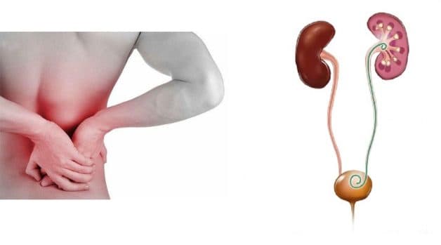 Đặt ống sonde jj niệu quản trong điều trị sỏi tiết niệu