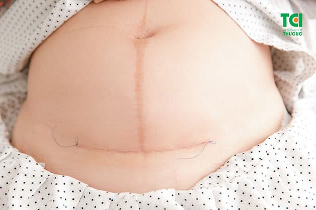 Sản phụ sau đẻ mổ cần kiêng cữ cẩn thận để tránh những biến chứng hậu sản nguy hiểm, đặc biệt là nhiễm trùng vết mổ