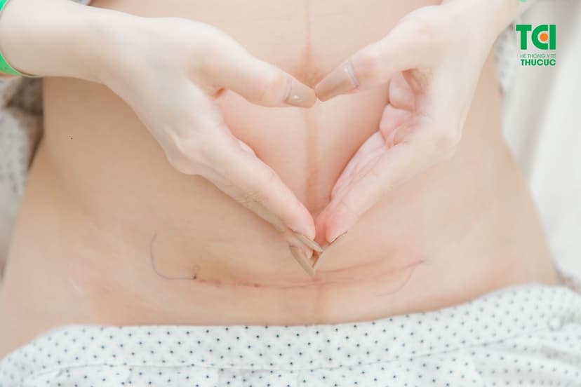 Giải đáp: Đẻ mổ dọc hay ngang? Cách chăm sóc vết mổ sau sinh