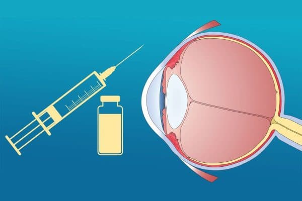 Tiêm Anti-VEGF là một trong những phương pháp thường được áp dụng để điều trị bệnh phù hoàng điểm