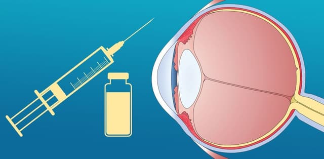 Nguyên tắc điều trị bệnh phù hoàng điểm