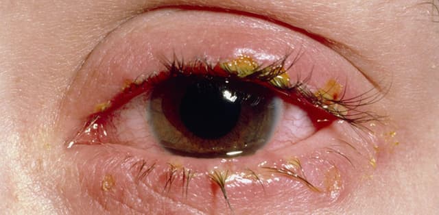 Điều trị bệnh viêm kết mạc mãn tính như thế nào?