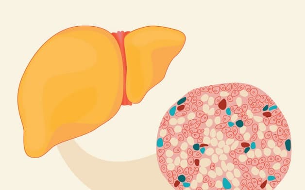 điều trị gan nhiễm mỡ độ 2