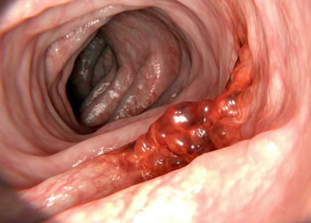 Điều trị HP kháng thuốc cần thực hiện kịp thời để ngăn biến chứng ung thư