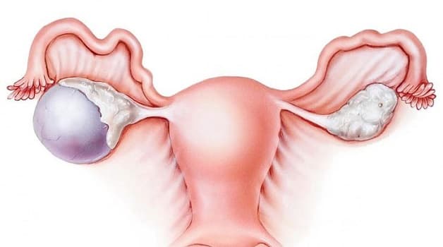 U nang buồng trứng hầu hết là các nang trứng không thoái hóa đi sau khi trứng đã rụng