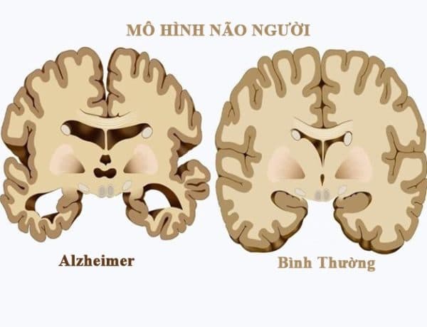 Não người thường và não người bị Alzheimer