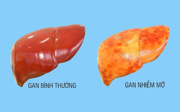 Gan nhiễm mỡ độ 3