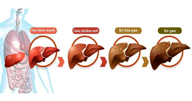 giải đáp gan nhiễm mỡ có lây không