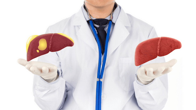 gan nhiễm mỡ có lây không