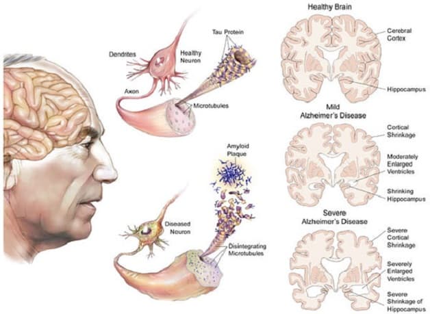 Giả thuyết tau lý giải cho nguyên nhân Alzheimer