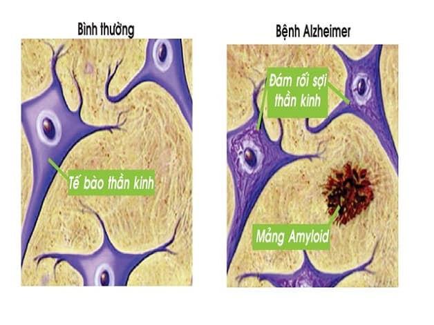 Giả thuyết amyloid gợi mở cho nguyên nhân Alzheimer