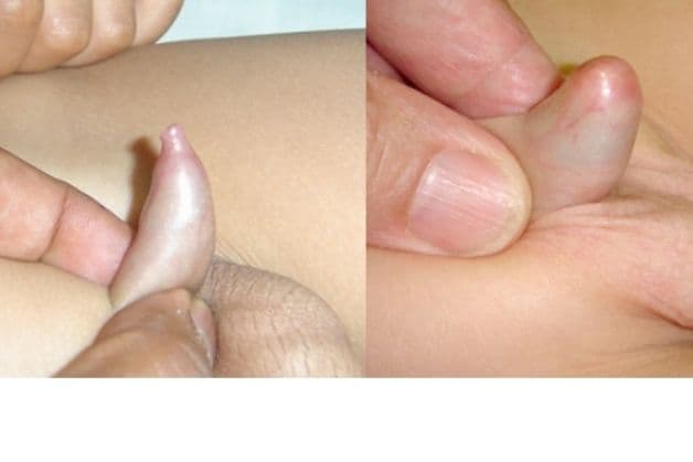 phân loại hẹp bao quy đầu ở trẻ em