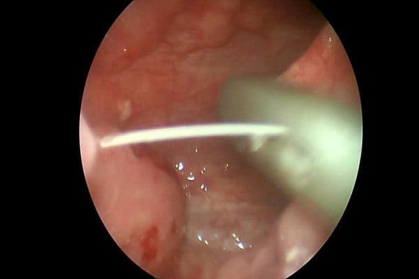 Xương cá dài 3 cm trong họng người bệnh. Ảnh: Bệnh viện cung cấp