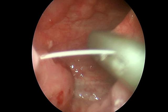 [Vnexpress.net] Loét họng sau ngậm vỏ quýt chữa hóc xương