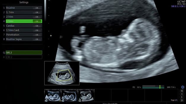 Khám thai đo độ mờ da gáy được thực hiện bằng phương pháp siêu âm từ tuần 11 đến 13 của thai kỳ