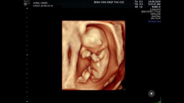 lịch siêu âm thai định kỳ tuần thứ 12