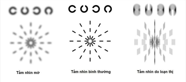 Những điều cần biết về loạn thị một mắt, loạn thị hai mắt