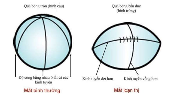 loạn thị một mắt