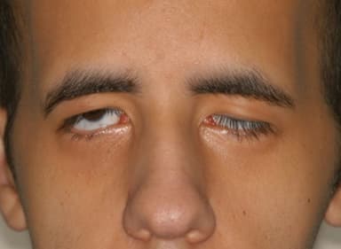 Bệnh mí mắt sụp, nguyên nhân gây mất thẩm mỹ và giảm thị lực