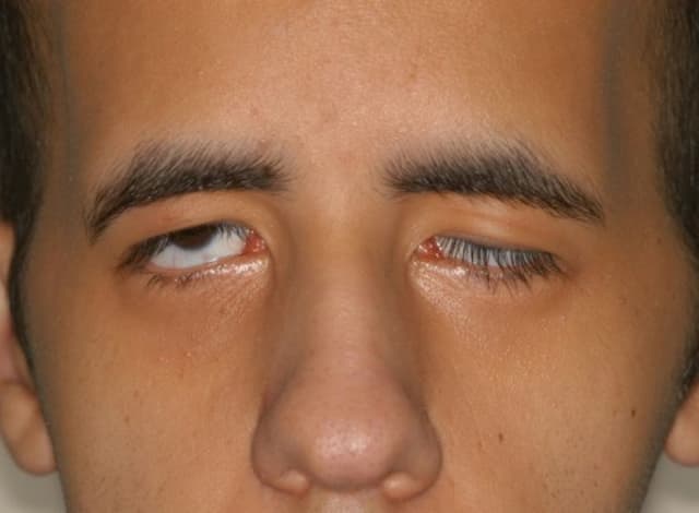 Bệnh mí mắt sụp, nguyên nhân gây mất thẩm mỹ và giảm thị lực