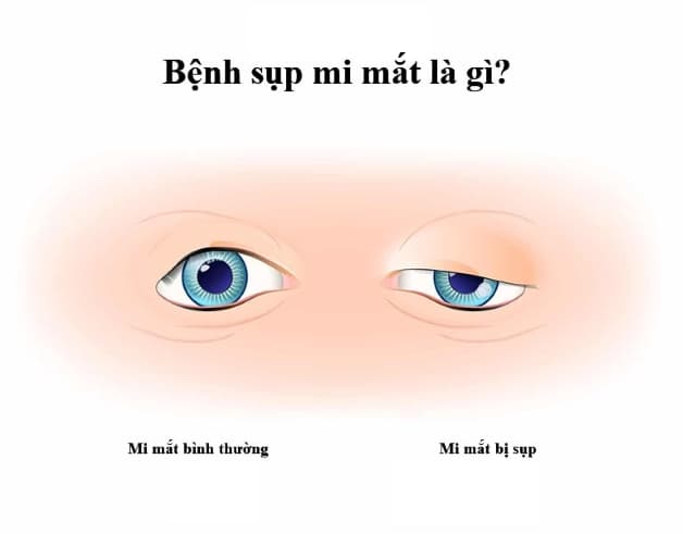 mí mắt sụp