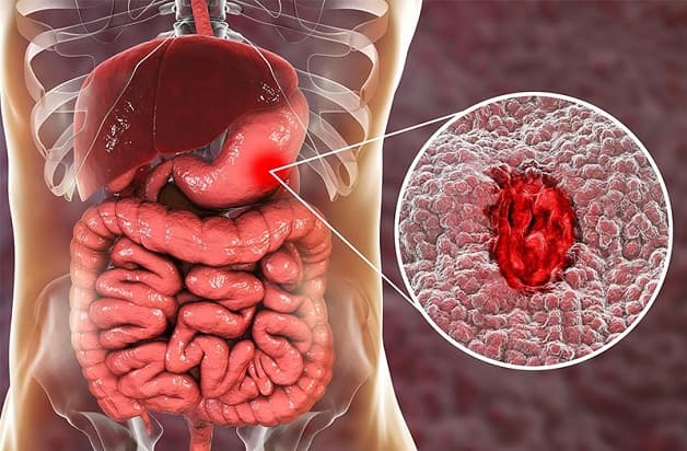 Viêm loét dạ dày là bệnh lý phổ biến ở hệ tiêu hóa