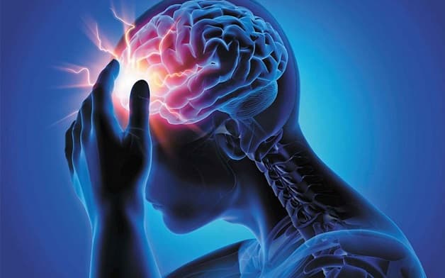 Đau đầu - dấu hiệu của đột quỵ