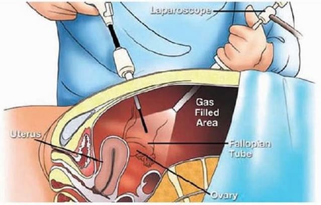 phẫu thuật nội soi