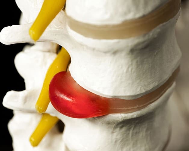 Phình đĩa đệm đốt sống cổ để lâu có thể hình thành thoát vị đĩa đệm