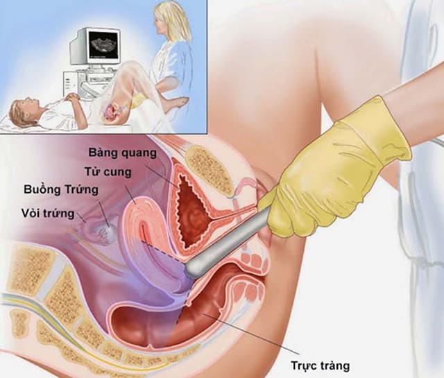 Liệu siêu âm u xơ tử cung có giúp chẩn đoán chính xác không?