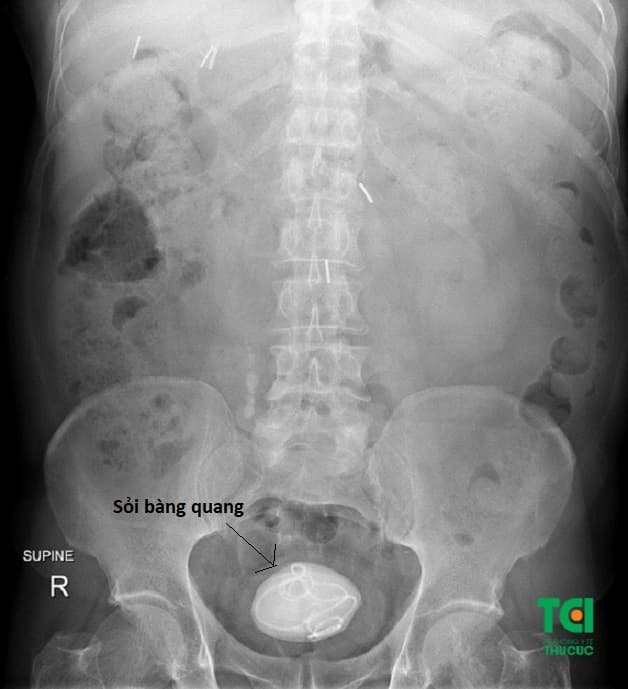 Lý giải mổ sỏi bàng quang có nguy hiểm không