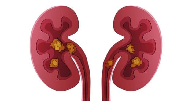 Các phương pháp tán sỏi thận nội soi