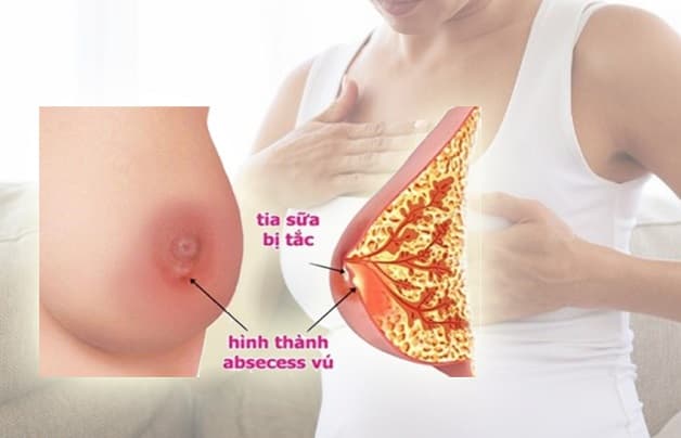 Tắc tia sữa là một trong những nguyên nhân chính gây ra áp xe vú