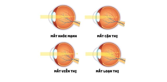 Các tật khúc xạ mắt ở trẻ em và cách phòng ngừa
