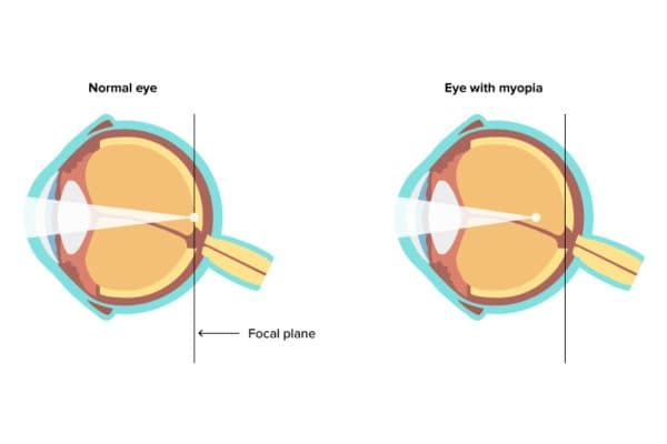 Cận thị là tật khúc xạ mắt ở trẻ em thường gặp nhất hiện nay