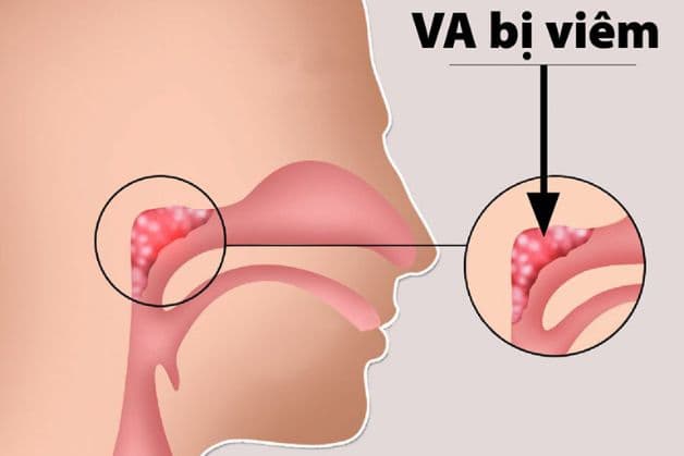 dấu hiệu trẻ bị viêm va