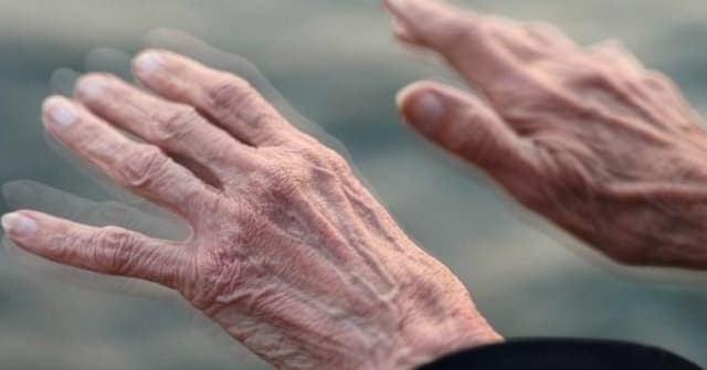 Những điều có thể bạn chưa biết về bệnh parkinson người già