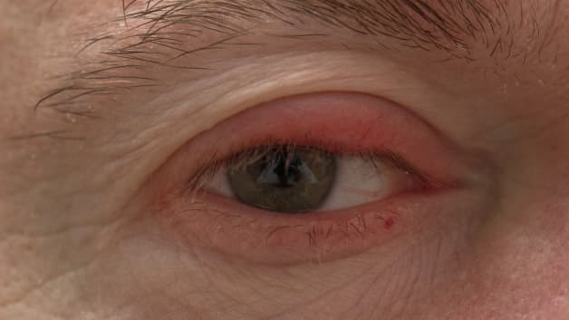 u hạt hốc mắt