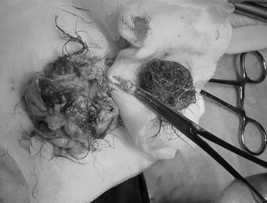 U nang buồng trứng: Bệnh có nguy hiểm không?