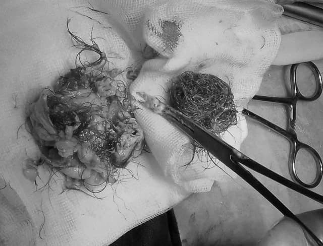 U nang buồng trứng: Bệnh có nguy hiểm không?