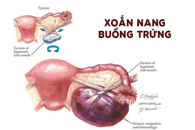 U nang buồng trứng xoắn nguy hiểm như thế nào?