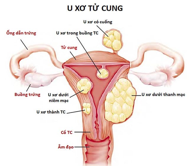 Những hiểm họa khôn lường từ tình trạng u xơ tử cung có cuống